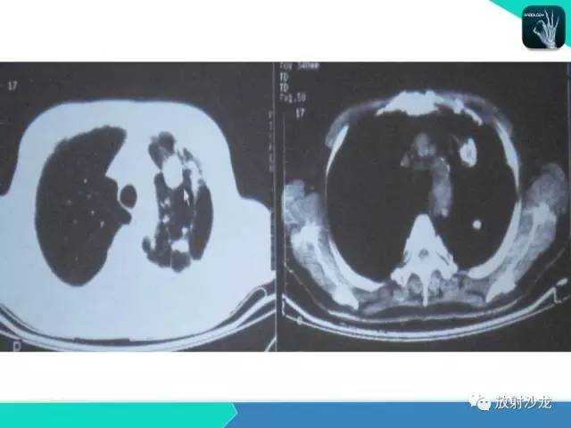 【PPT】浅谈周围型肺癌的CT诊断