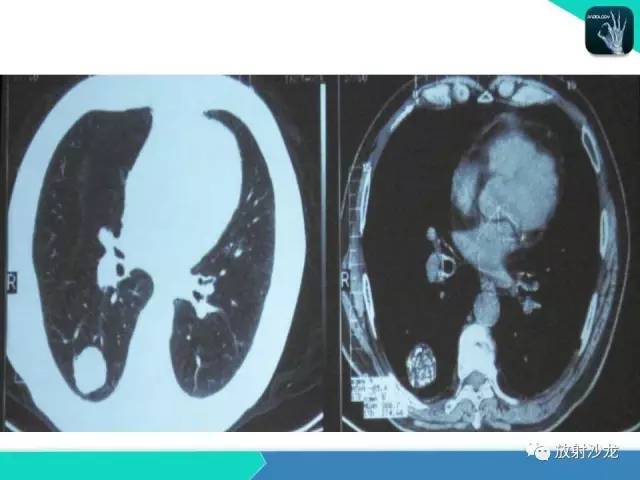 【PPT】浅谈周围型肺癌的CT诊断