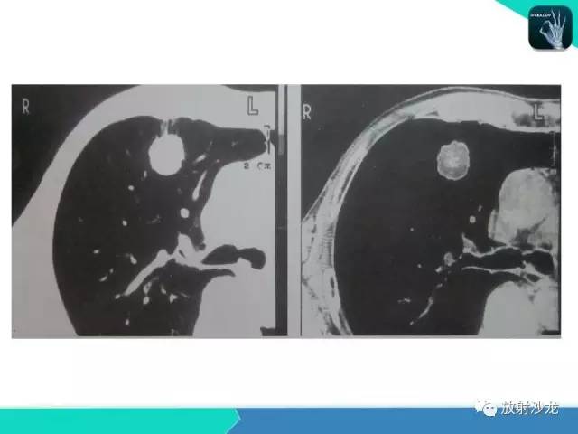 【PPT】浅谈周围型肺癌的CT诊断