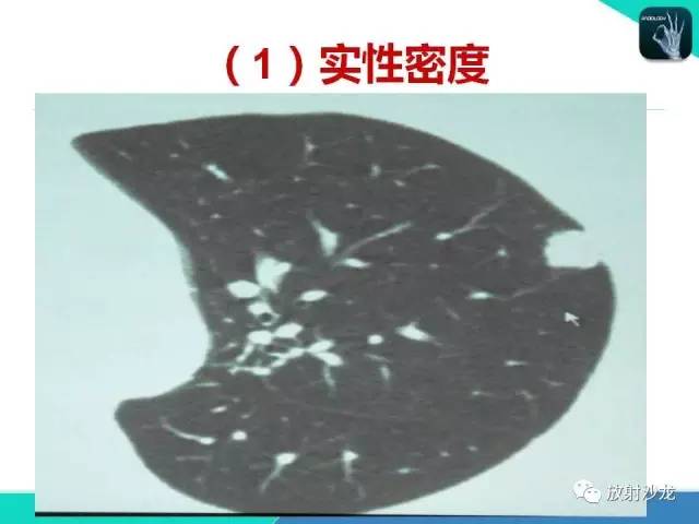 【PPT】浅谈周围型肺癌的CT诊断