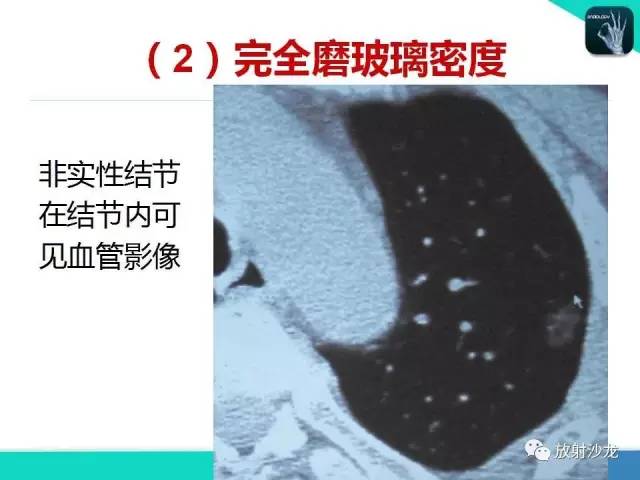 【PPT】浅谈周围型肺癌的CT诊断