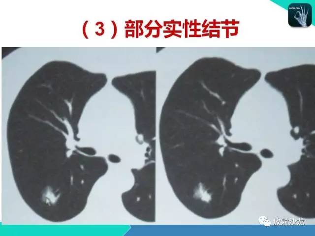 【PPT】浅谈周围型肺癌的CT诊断
