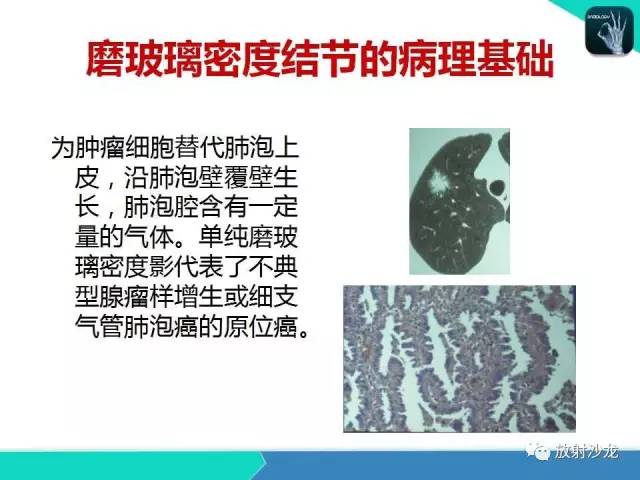 【PPT】浅谈周围型肺癌的CT诊断