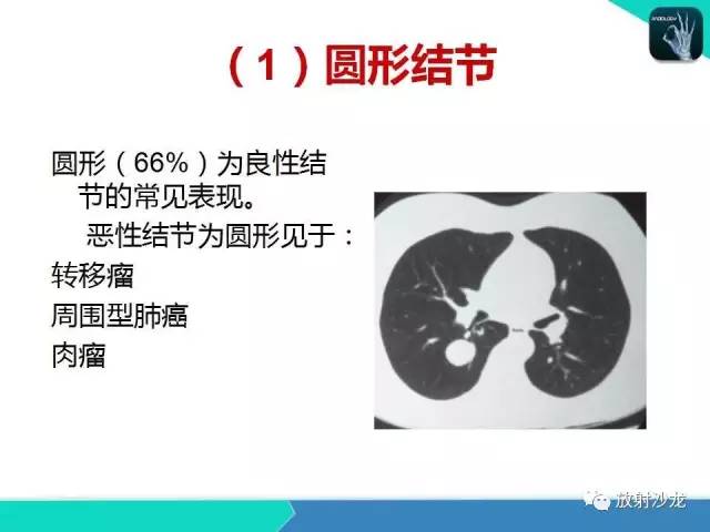 【PPT】浅谈周围型肺癌的CT诊断