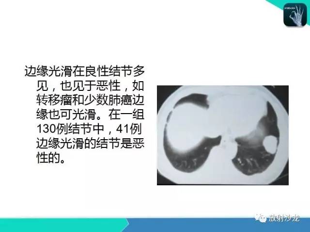 【PPT】浅谈周围型肺癌的CT诊断