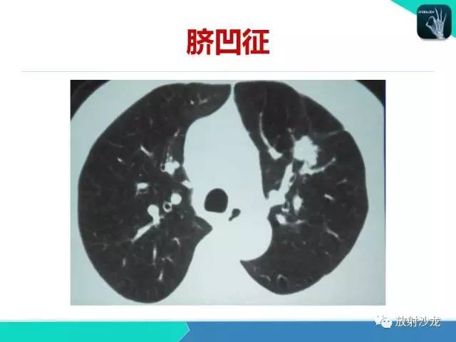【PPT】浅谈周围型肺癌的CT诊断