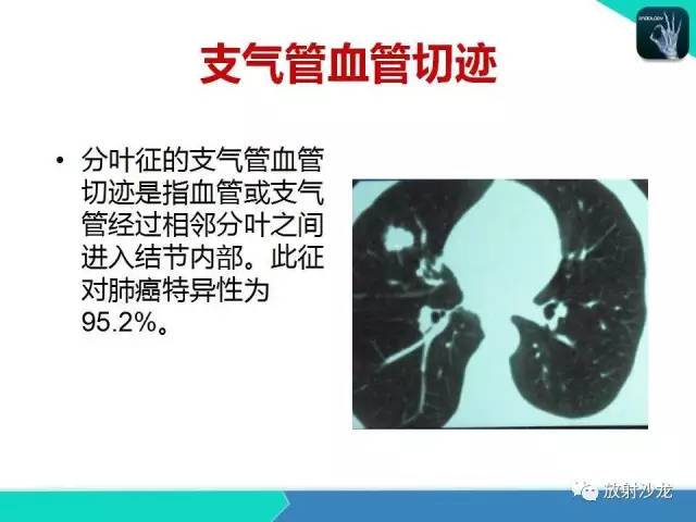 【PPT】浅谈周围型肺癌的CT诊断