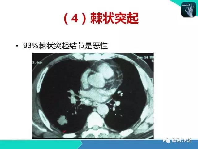 【PPT】浅谈周围型肺癌的CT诊断