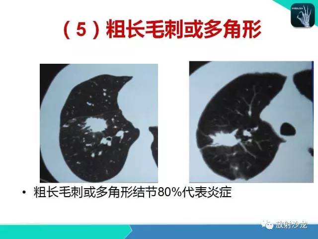 【PPT】浅谈周围型肺癌的CT诊断