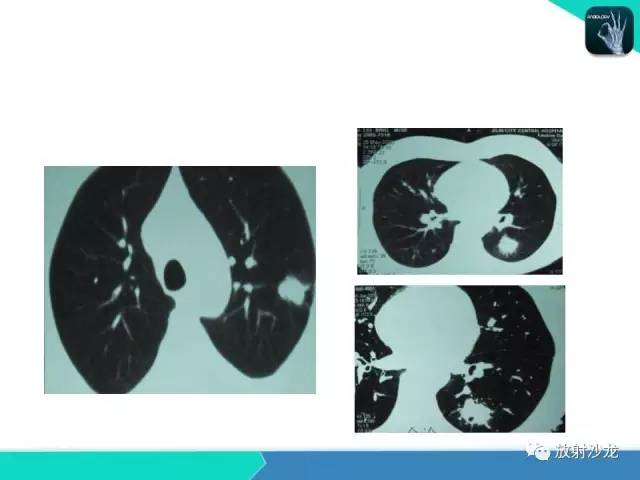 【PPT】浅谈周围型肺癌的CT诊断