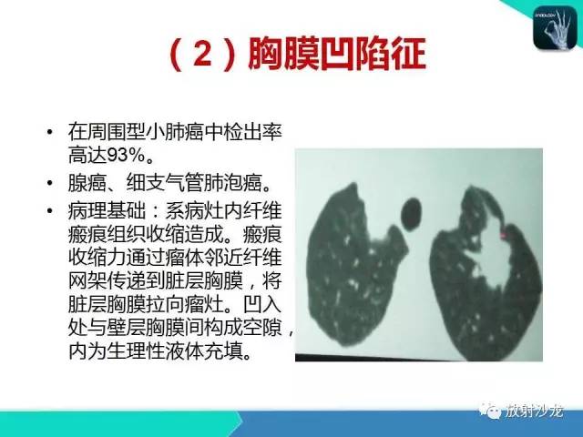 【PPT】浅谈周围型肺癌的CT诊断