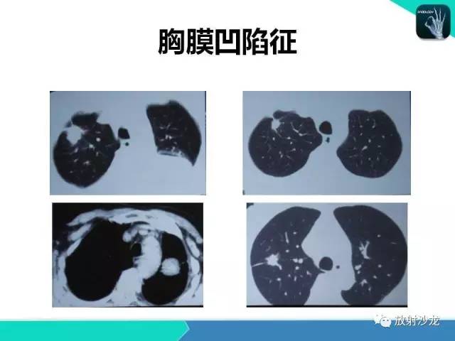 【PPT】浅谈周围型肺癌的CT诊断