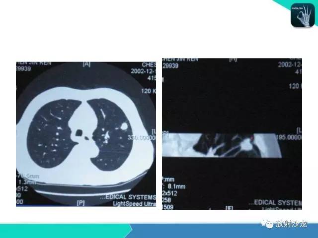 【PPT】浅谈周围型肺癌的CT诊断