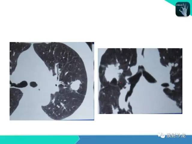 【PPT】浅谈周围型肺癌的CT诊断
