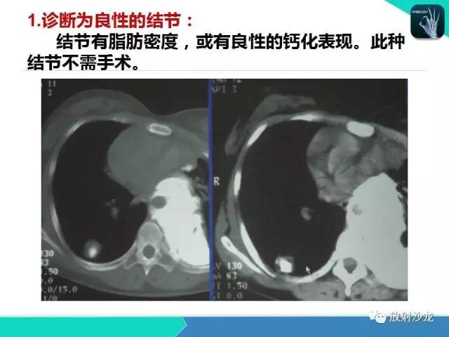 【PPT】浅谈周围型肺癌的CT诊断