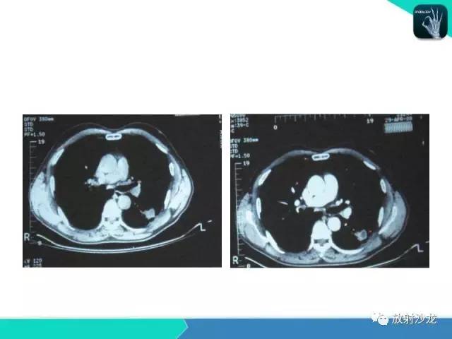 【PPT】浅谈周围型肺癌的CT诊断