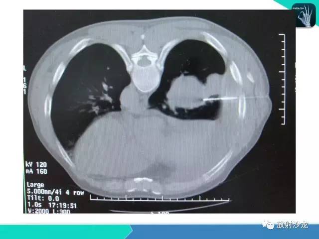 【PPT】浅谈周围型肺癌的CT诊断