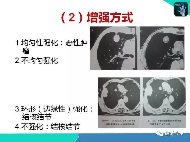 【PPT】浅谈周围型肺癌的CT诊断