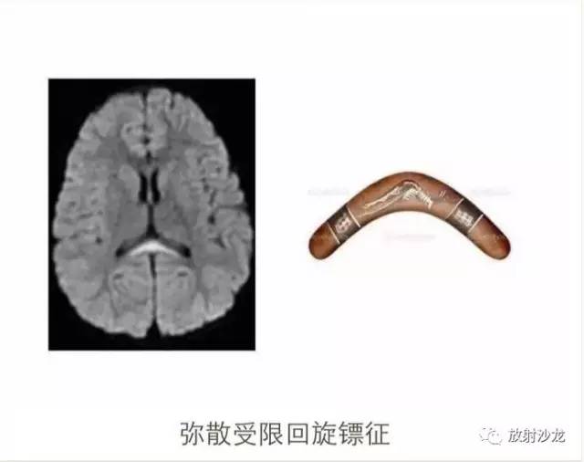 可逆性胼胝体压部病变综合征RESLES