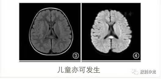 可逆性胼胝体压部病变综合征RESLES 可逆性胼胝体压部病变综合征RESLES