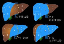 肝脏解剖分段图解 肝脏解剖分段图解