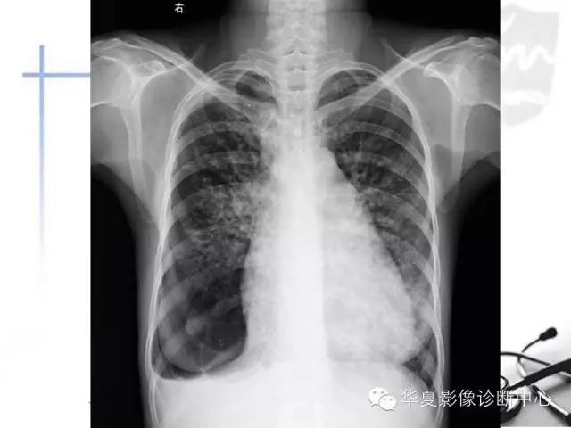 【PPT】X线如何区分肺水肿和肺淤血