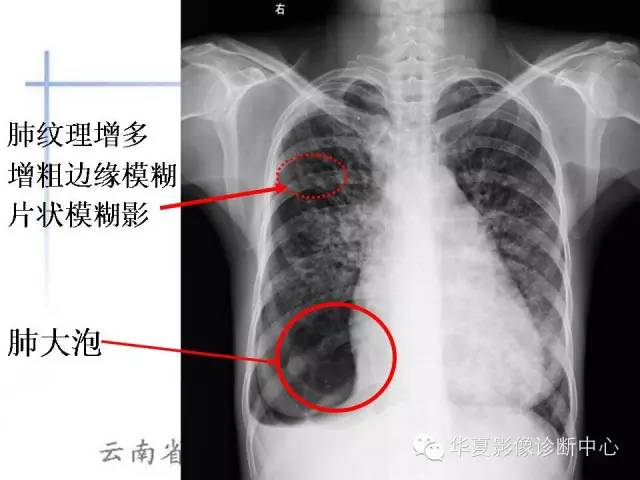 【PPT】X线如何区分肺水肿和肺淤血