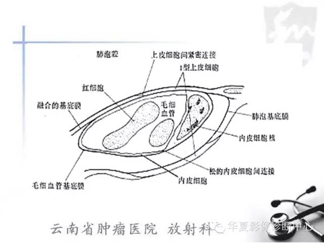 【PPT】X线如何区分肺水肿和肺淤血