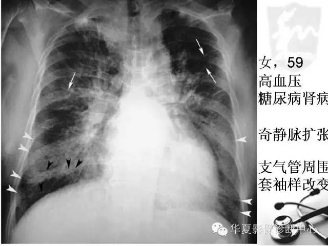 【PPT】X线如何区分肺水肿和肺淤血