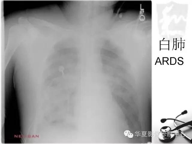 【PPT】X线如何区分肺水肿和肺淤血