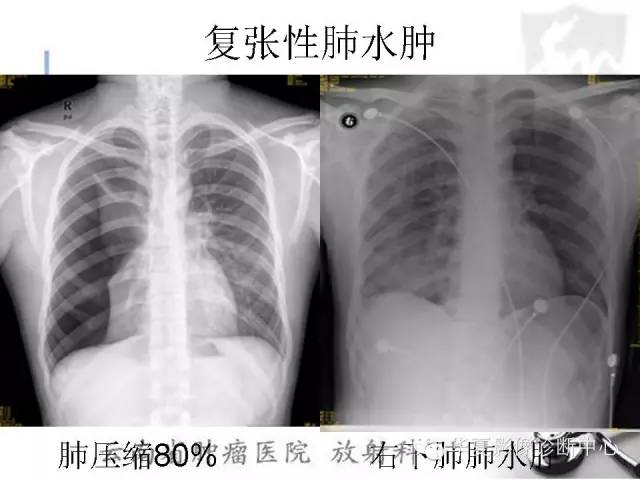 【PPT】X线如何区分肺水肿和肺淤血