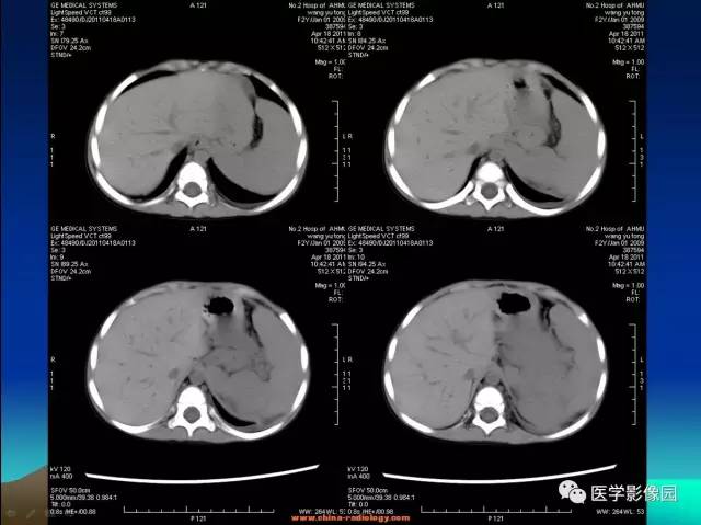 【病例】左肾上腺区神经母细胞瘤1例CT影像表现
