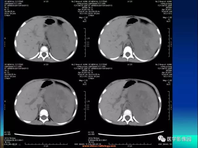 【病例】左肾上腺区神经母细胞瘤1例CT影像表现 【病例】左肾上腺区神经母细胞瘤1例CT影像表现