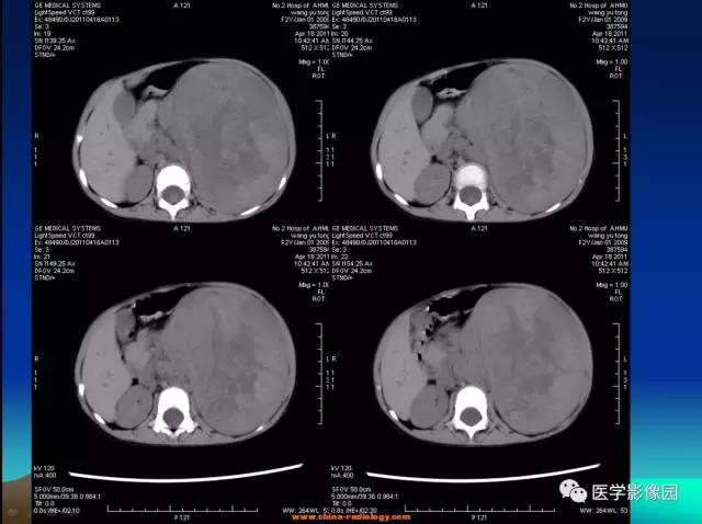 【病例】左肾上腺区神经母细胞瘤1例CT影像表现 【病例】左肾上腺区神经母细胞瘤1例CT影像表现