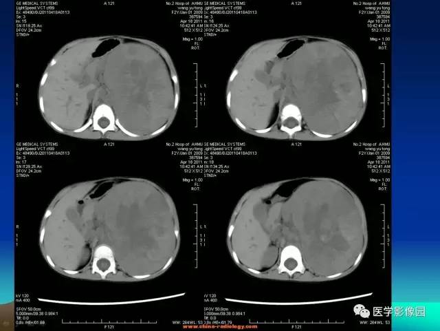 【病例】左肾上腺区神经母细胞瘤1例CT影像表现 【病例】左肾上腺区神经母细胞瘤1例CT影像表现