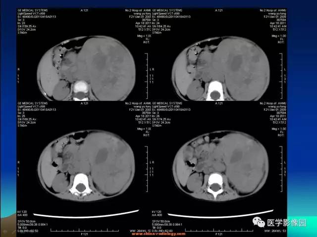 【病例】左肾上腺区神经母细胞瘤1例CT影像表现 【病例】左肾上腺区神经母细胞瘤1例CT影像表现