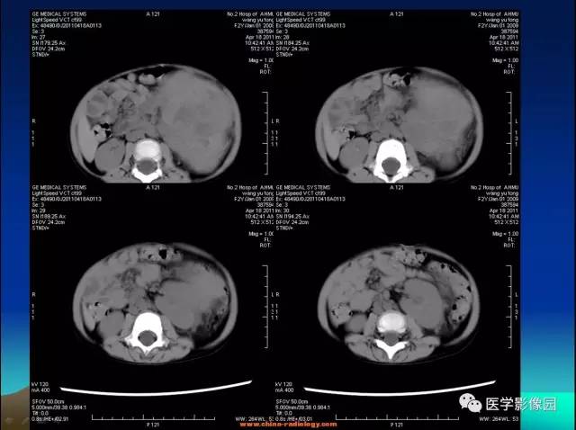 【病例】左肾上腺区神经母细胞瘤1例CT影像表现 【病例】左肾上腺区神经母细胞瘤1例CT影像表现