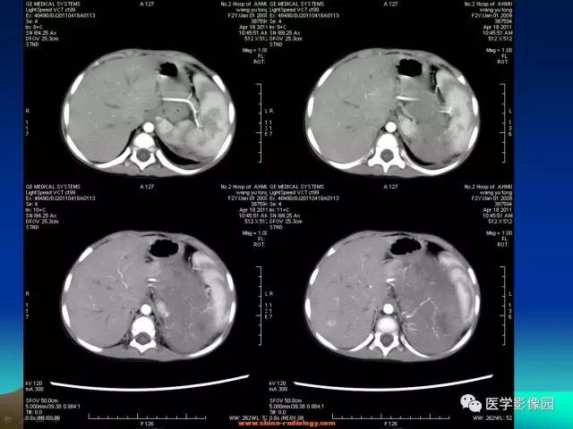 【病例】左肾上腺区神经母细胞瘤1例CT影像表现 【病例】左肾上腺区神经母细胞瘤1例CT影像表现