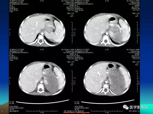 【病例】左肾上腺区神经母细胞瘤1例CT影像表现 【病例】左肾上腺区神经母细胞瘤1例CT影像表现