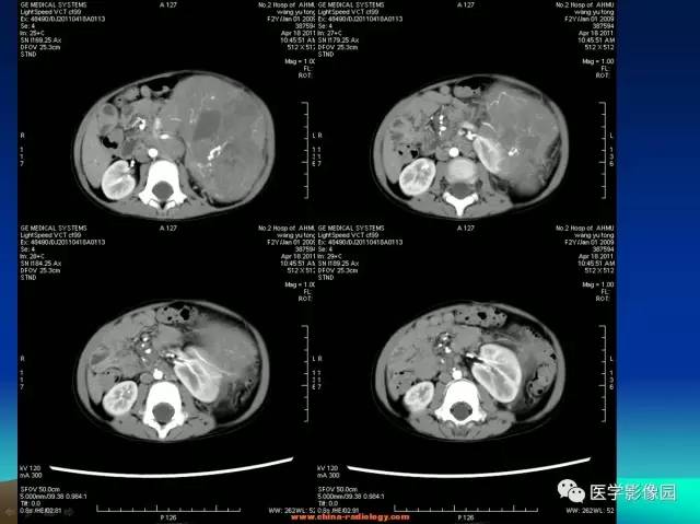【病例】左肾上腺区神经母细胞瘤1例CT影像表现 【病例】左肾上腺区神经母细胞瘤1例CT影像表现