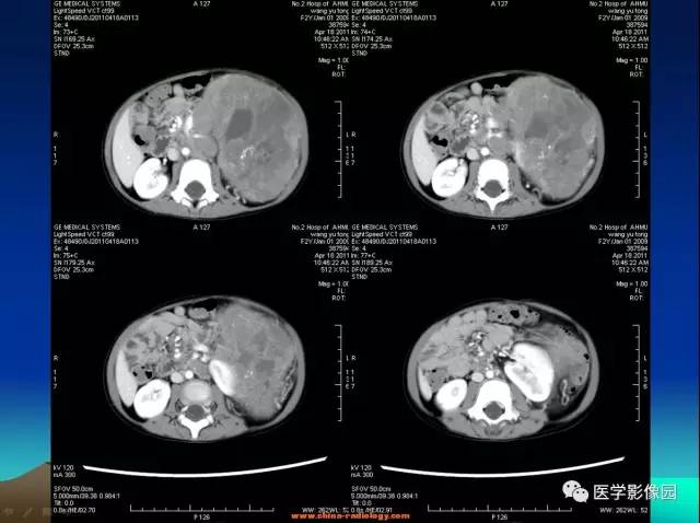 【病例】左肾上腺区神经母细胞瘤1例CT影像表现 【病例】左肾上腺区神经母细胞瘤1例CT影像表现