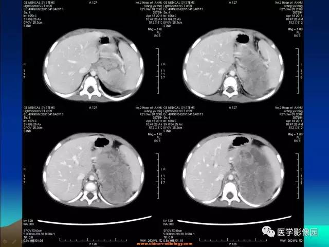 【病例】左肾上腺区神经母细胞瘤1例CT影像表现 【病例】左肾上腺区神经母细胞瘤1例CT影像表现