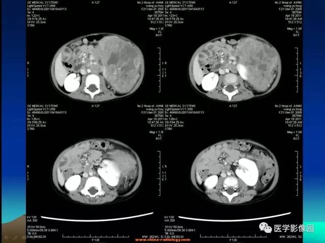 【病例】左肾上腺区神经母细胞瘤1例CT影像表现 【病例】左肾上腺区神经母细胞瘤1例CT影像表现