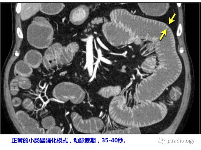 【PPT】肠壁增厚的CT鉴别诊断