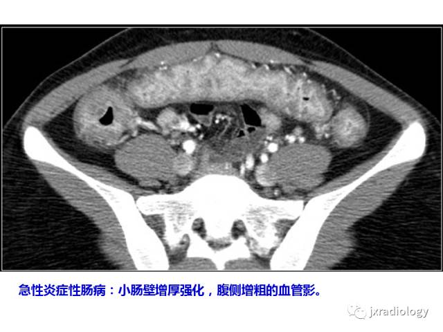 【PPT】肠壁增厚的CT鉴别诊断