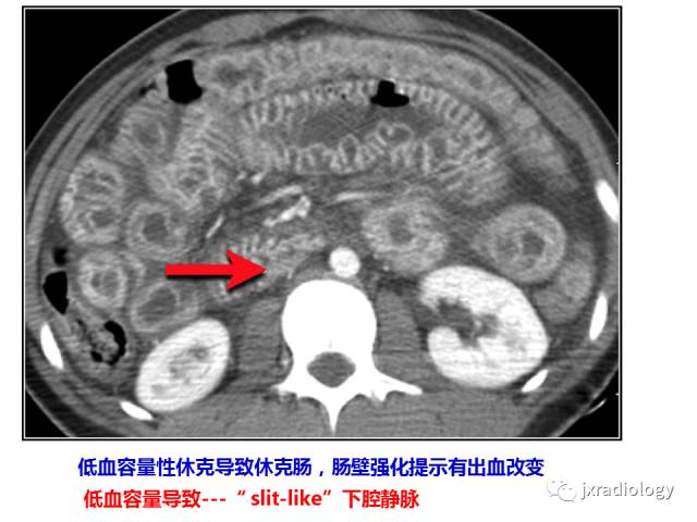 【PPT】肠壁增厚的CT鉴别诊断