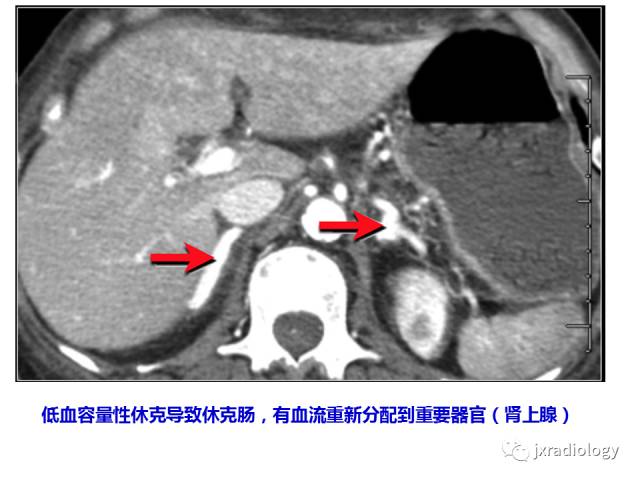 【PPT】肠壁增厚的CT鉴别诊断