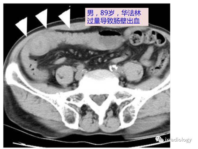 【PPT】肠壁增厚的CT鉴别诊断