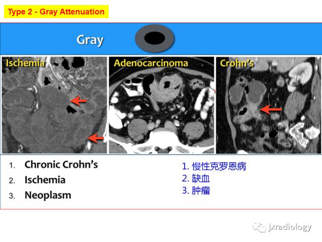 【PPT】肠壁增厚的CT鉴别诊断
