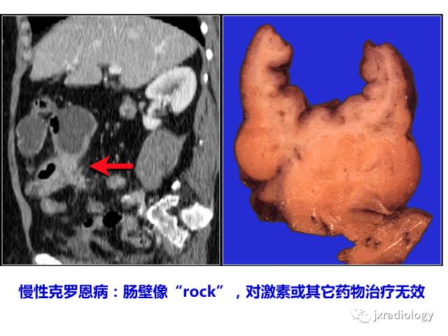【PPT】肠壁增厚的CT鉴别诊断